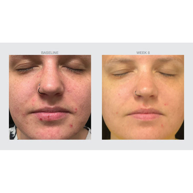 Tull MD Blemish Correcting Serum — acne treatment before and after photos