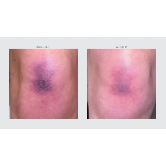 Before and after comparison of a skin condition on a person's knee, labeled 'Baseline' and 'Week 2'.